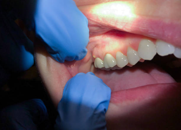 Best Emergency Dental Care for Abscessed Tooth in Fremont, NC
